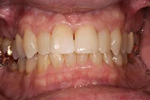 after All Ceramic Crown Upper Left Central Incisor