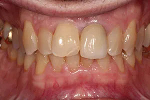 before All Ceramic Crown Upper Left Central Incisor