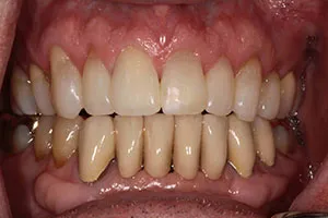 after All Ceramic Crown Replacing Failed Upper Right Central Incisor