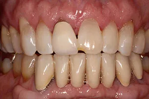 before All Ceramic Crown Replacing Failed Upper Right Central Incisor