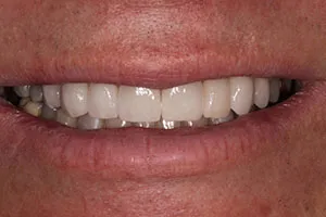 after Upper Anterior Crowns Following Orthodontic Treatment