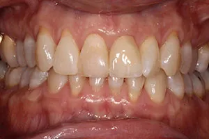 after Ceramic Crown Replacing Upper Left Central Incisor
