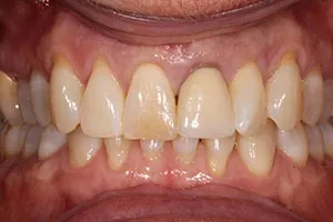 before Ceramic Crown Replacing Upper Left Central Incisor