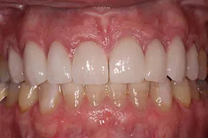 after Upper Anterior Crowns Following Orthodontic Treatment