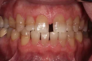 before Upper Anterior Crowns Following Orthodontic Treatment
