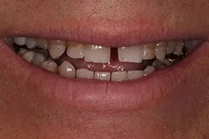 before Upper Anterior Crowns Following Orthodontic Treatment