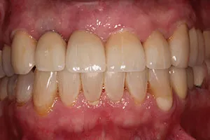 after All Ceramic Crowns Replacing Failing Crowns and Composites