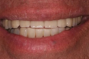 after All Ceramic Crowns Replacing Failing Crowns and Composites