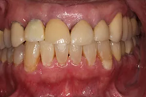 before All Ceramic Crowns Replacing Failing Crowns and Composites