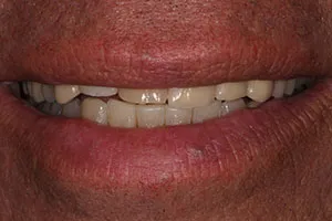 before All Ceramic Crowns Replacing Failing Crowns and Composites