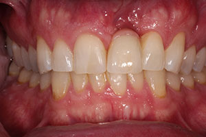 after Implant Placed in Upper Left Central Incisor Following Trauma