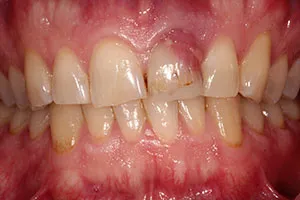 before Implant Placed in Upper Left Central Incisor Following Trauma
