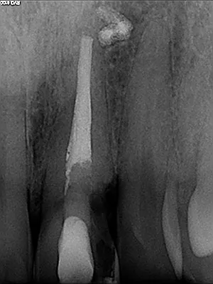 before Implant Placed in Upper Left Central Incisor Following Trauma