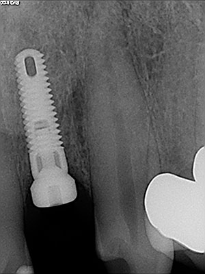 after Implants Upper Right/Left Lateral Incisors with All Ceramic Crowns