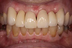 after Implants Upper Right/Left Lateral Incisors with All Ceramic Crowns