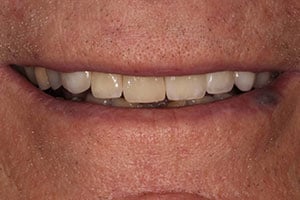 after Implants Upper Right/Left Lateral Incisors with All Ceramic Crowns