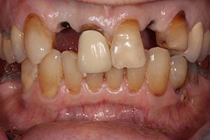 before Implants Upper Right/Left Lateral Incisors with All Ceramic Crowns