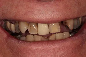 before Implants Upper Right/Left Lateral Incisors with All Ceramic Crowns