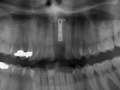 after Implant Placed in Upper Left Central Incisor Following Trauma