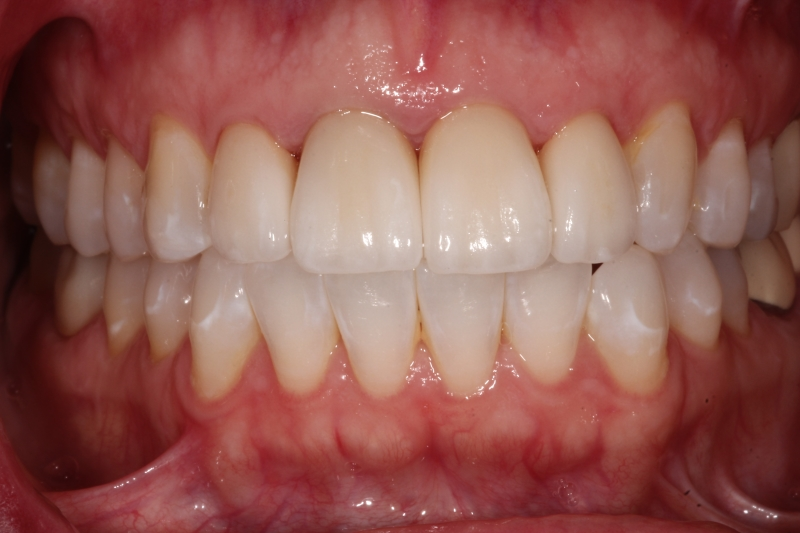 after Upper Anterior Ceramic Crowns Replacing Failing Old Crowns