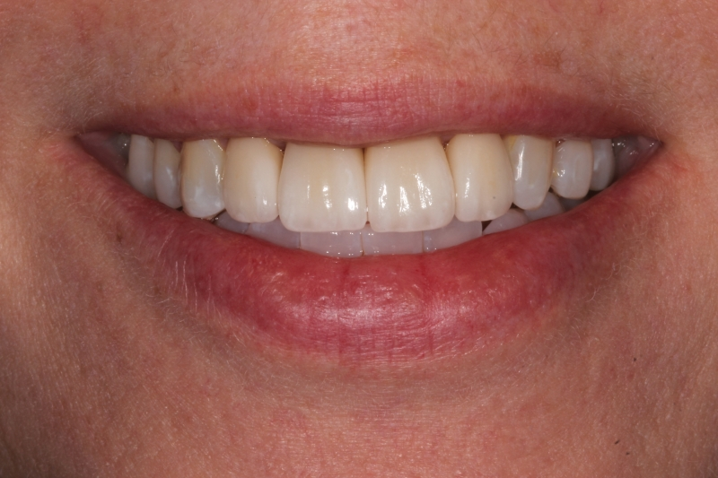 after Upper Anterior Ceramic Crowns Replacing Failing Old Crowns
