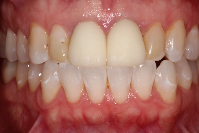 before Upper Anterior Ceramic Crowns Replacing Failing Old Crowns