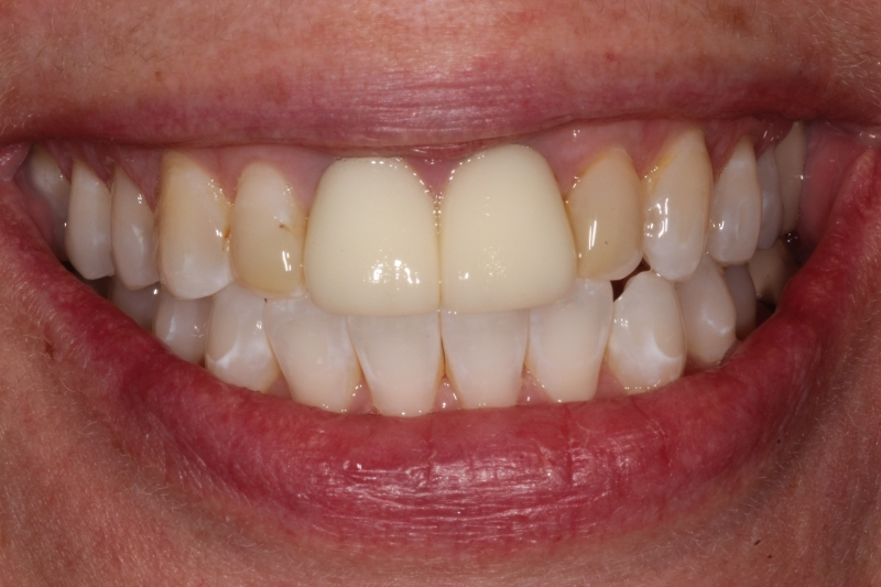 before Upper Anterior Ceramic Crowns Replacing Failing Old Crowns