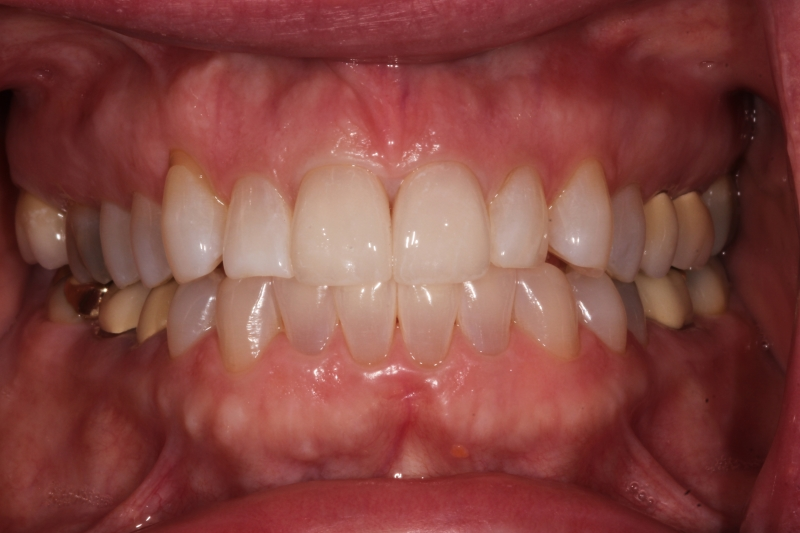after All Ceramic Crowns for Upper Central Incisors with Failing Older Composite Fillings