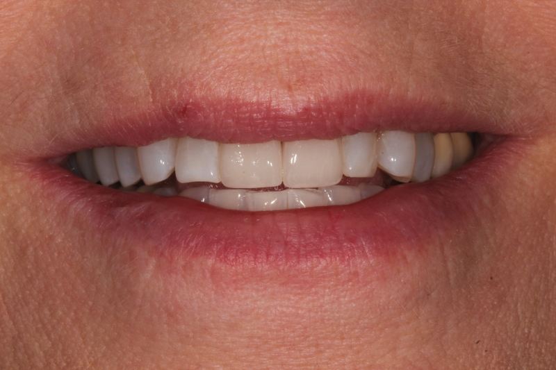 after All Ceramic Crowns for Upper Central Incisors with Failing Older Composite Fillings