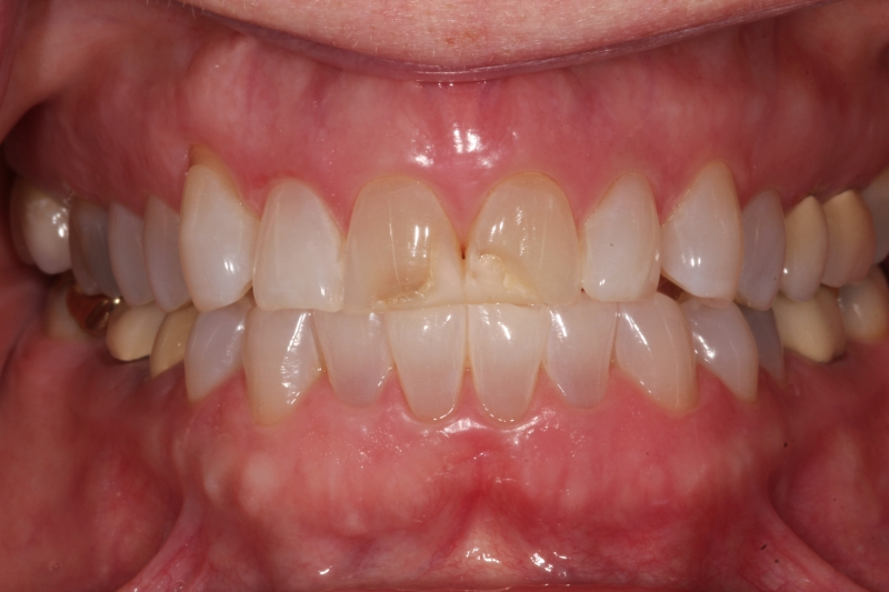before All Ceramic Crowns for Upper Central Incisors with Failing Older Composite Fillings