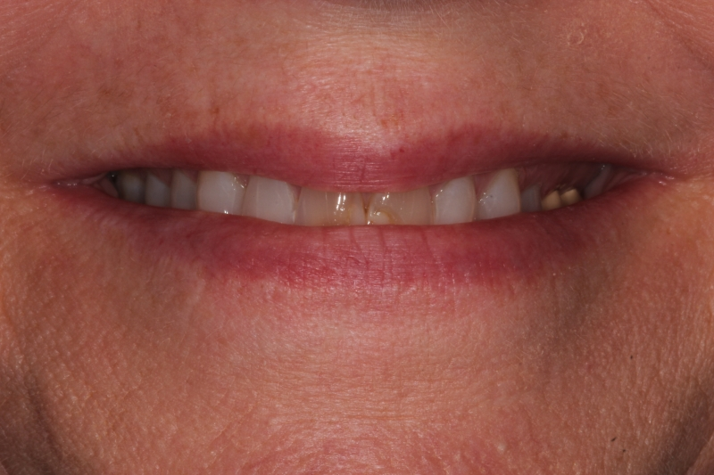 before All Ceramic Crowns for Upper Central Incisors with Failing Older Composite Fillings